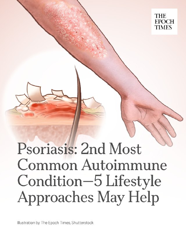 The immune system mistakenly attacks healthy skin cells, causing them to build u…