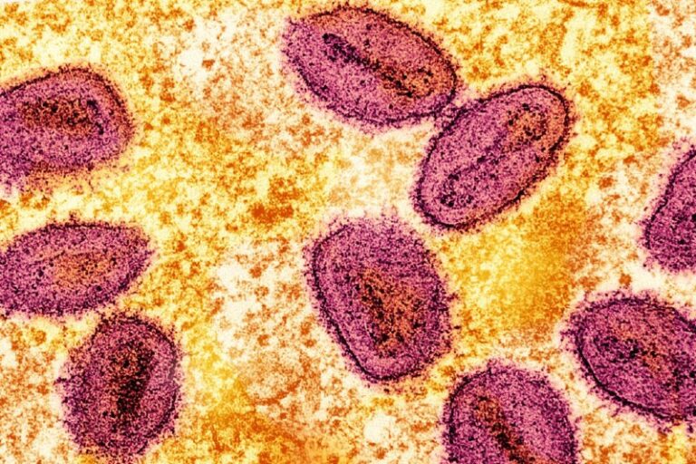 First Locally Acquired US Case of Severe Mpox Strain Identified in CaliforniaRe…